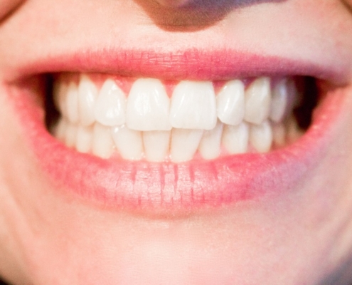 Sbiancamento dentale