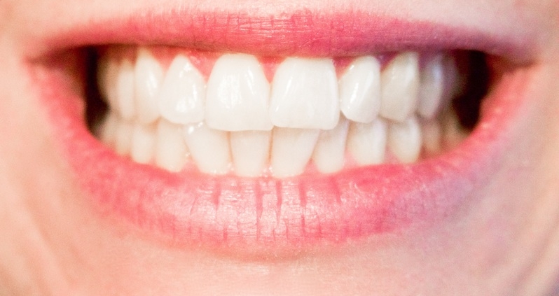 Sbiancamento dentale